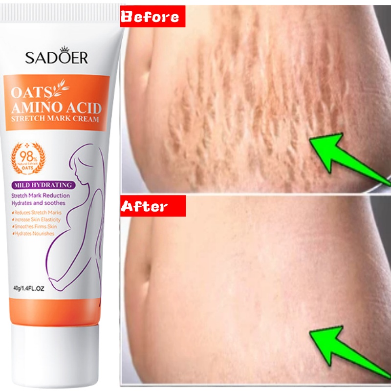 Skincare Oat - ストレッチマーク永久除去クリーム 体の腹部のストレッチマークを解消 腫れ跡を除去 皮膚のひび割れを修復 引き締めケア